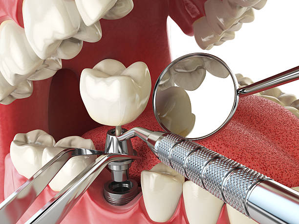 Best Urgent Care for Lost Fillings or Crowns in La Porte, TX
